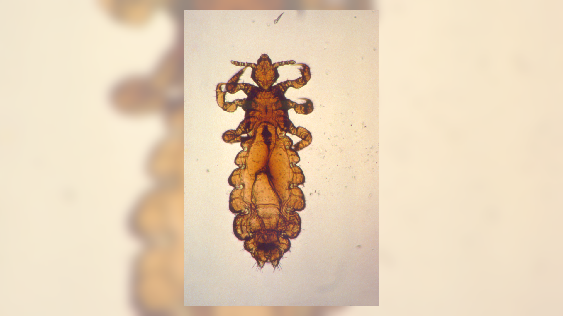 Adult head louse under magnification illustrating why super lice can survive over-the-counter shampoo treatments
