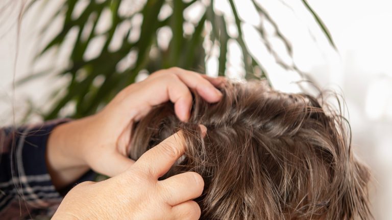 Is It Lice or Dandruff in Your Child’s Hair?