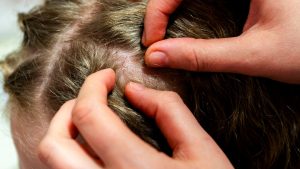 Young woman applying coconut oil to her hair in a bright home bathroom, the kind of at-home remedy parents reach for after a lice diagnosis