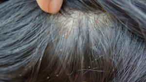 Why Head Lice Survived 100,000 Years of Human Evolution
