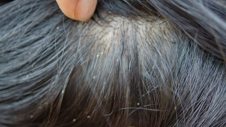 Why Head Lice Survived 100,000 Years of Human Evolution