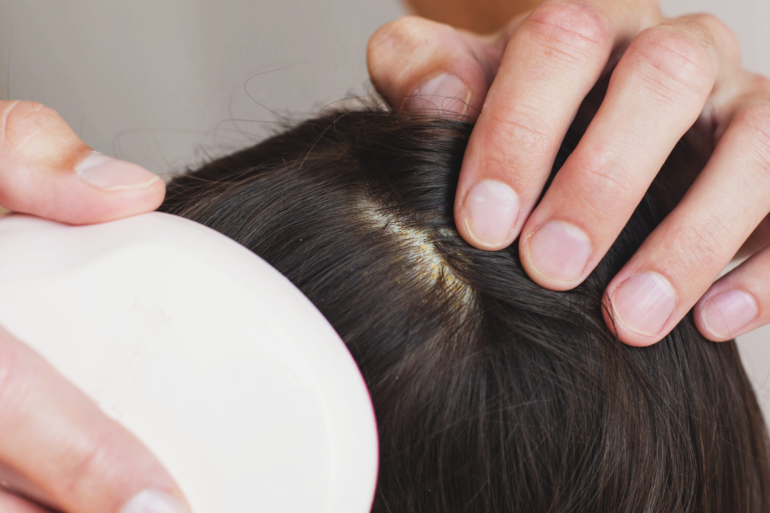 Close up view of dark brown hair with visible dandruff flakes seborrheic dermatitis on scalp, hands parting strands to show irritation, lice infestation ... See More