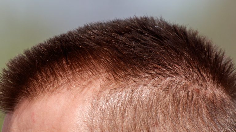 Why a Shaved Head Isn’t Safe From Head Lice