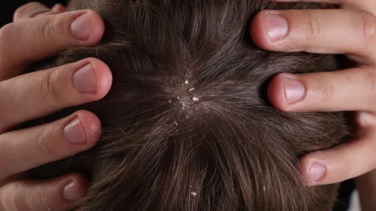 No Glow, No Lice? Why Broward Parents Should Check Again